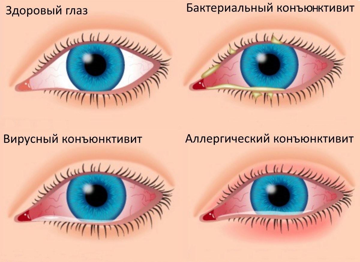 Хламидиоз глаз